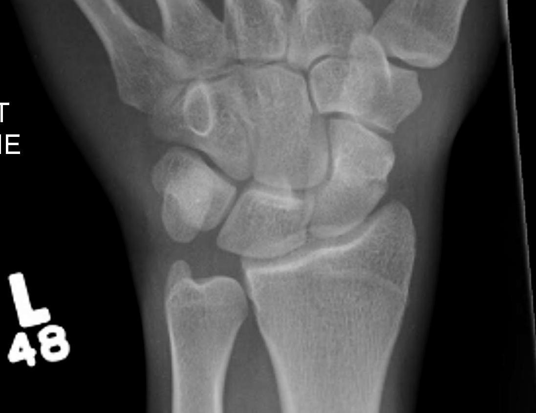 Scaphoid-fracture-in-a-bicycle-accident