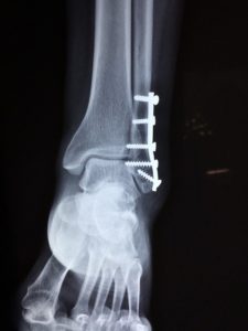 Broken Ankle