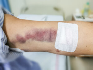 motorcycle accident bruises